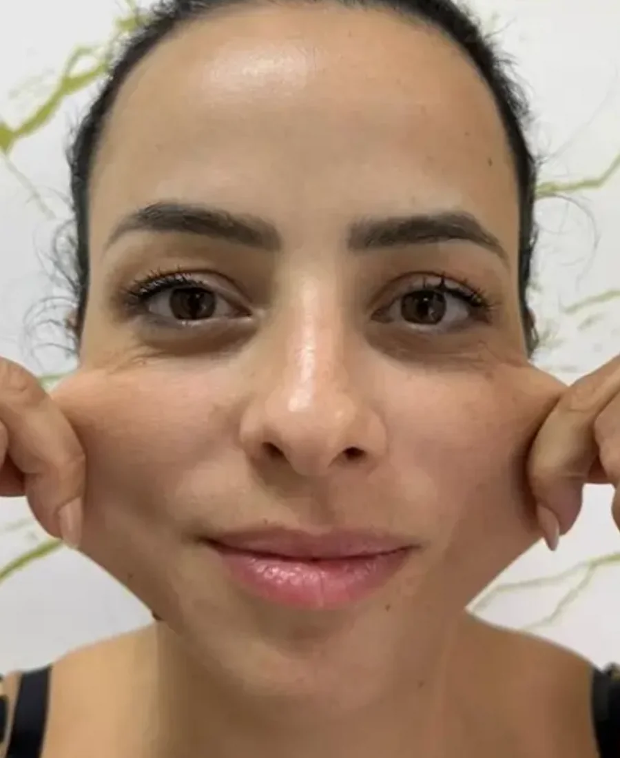 Antes: bioestimulador de colágeno