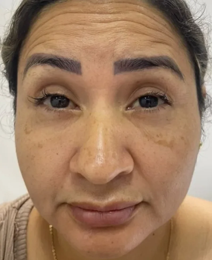 Antes: botox e bioestimulador