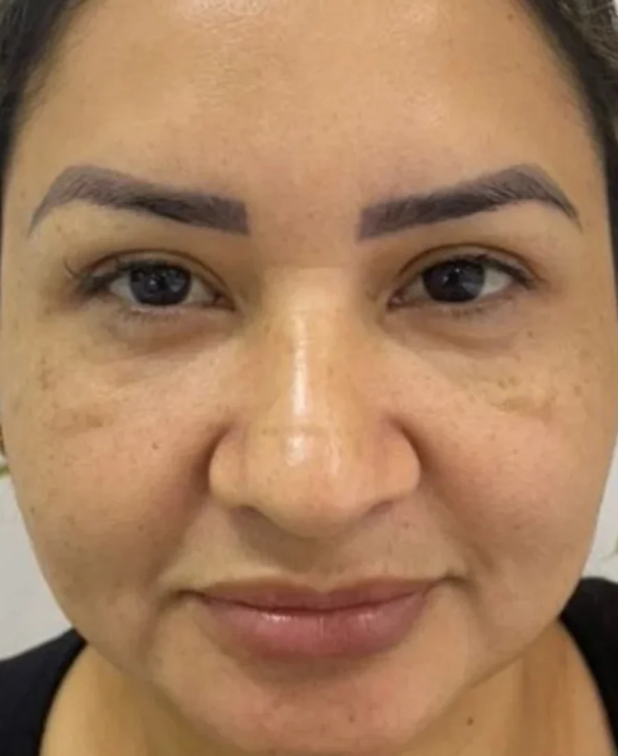 Depois: botox e bioestimulador