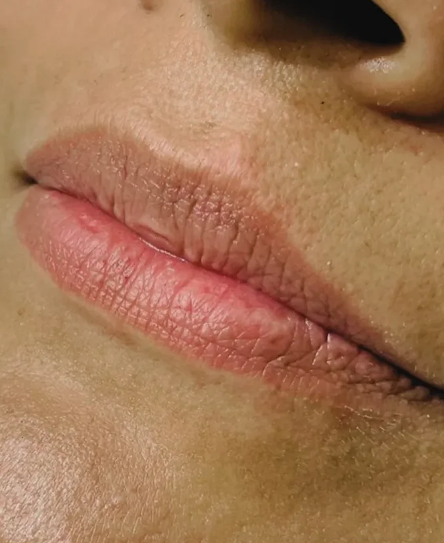 Antes: preenchimento labial