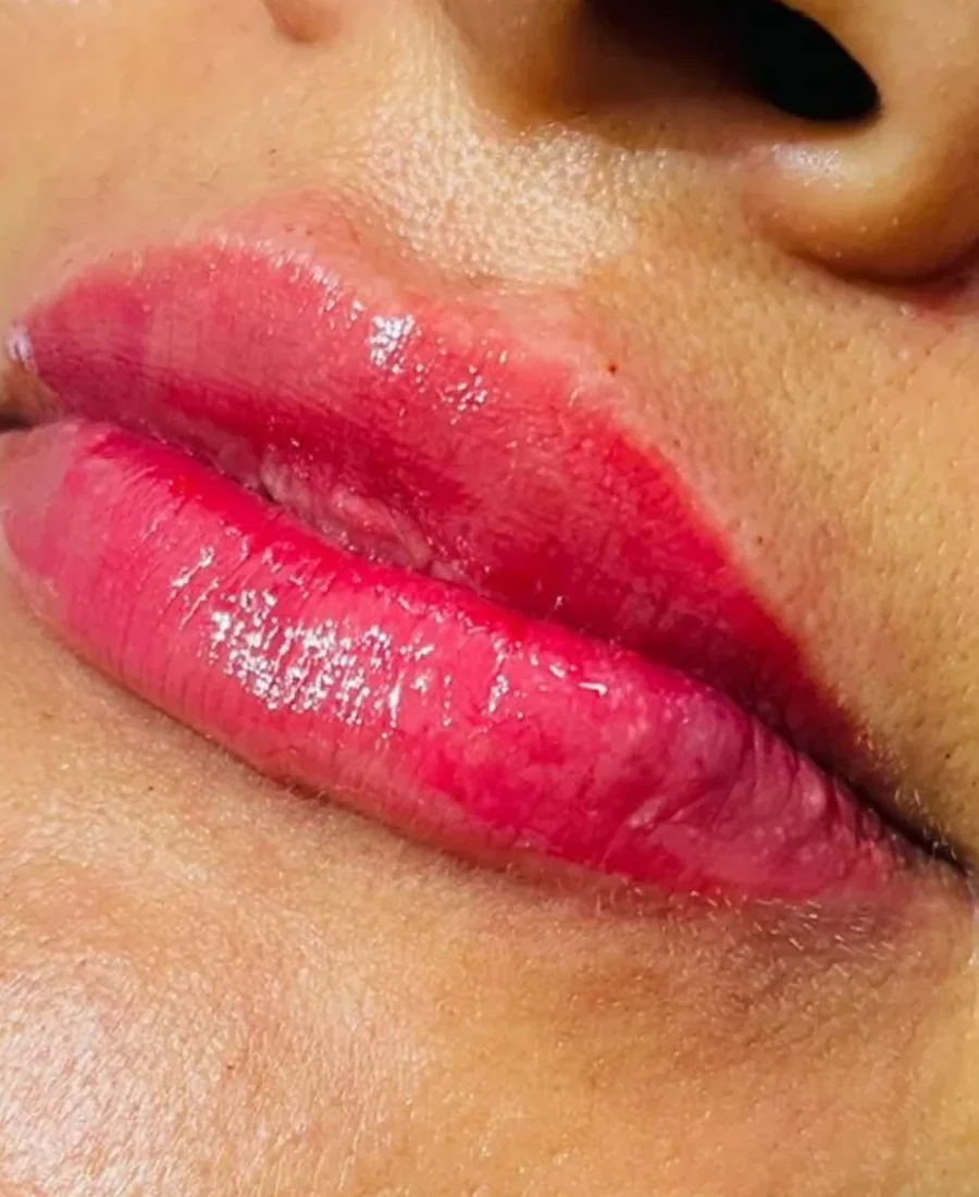 Depois: preenchimento labial