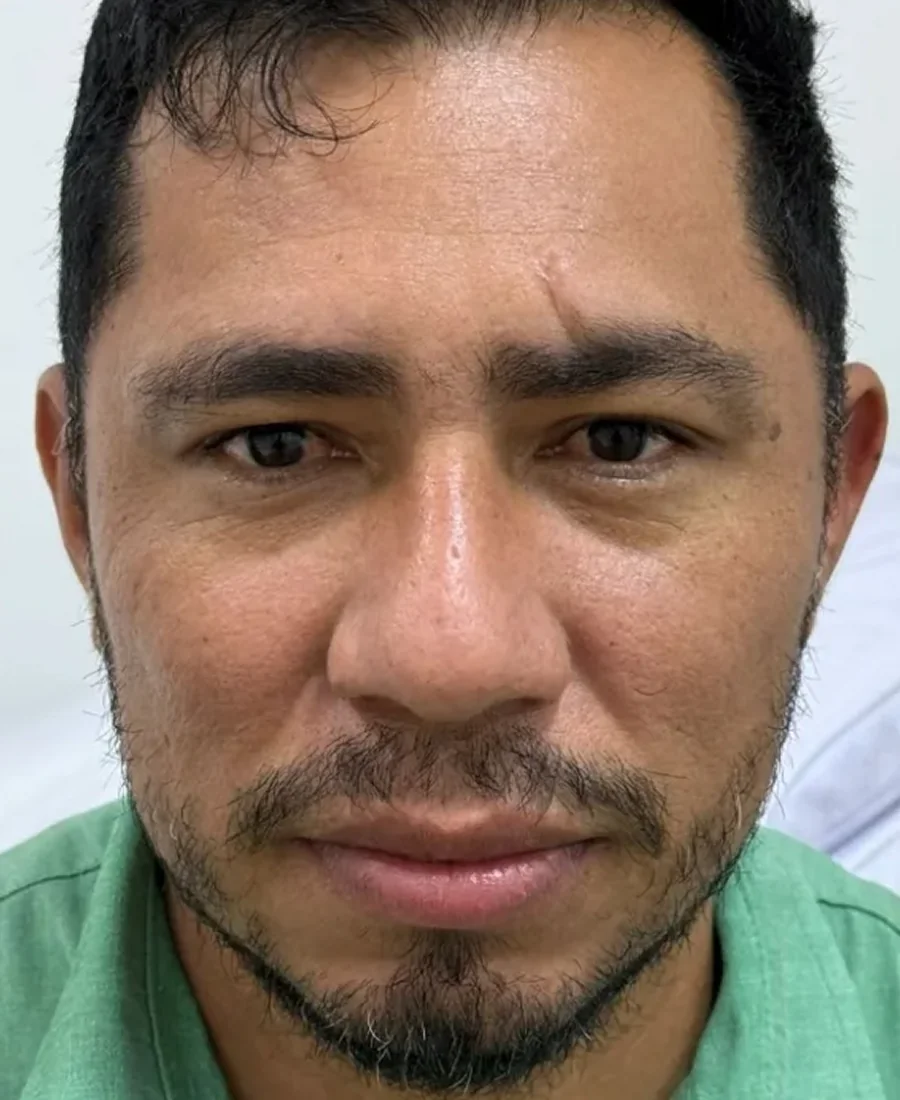 Antes: limpeza de pele