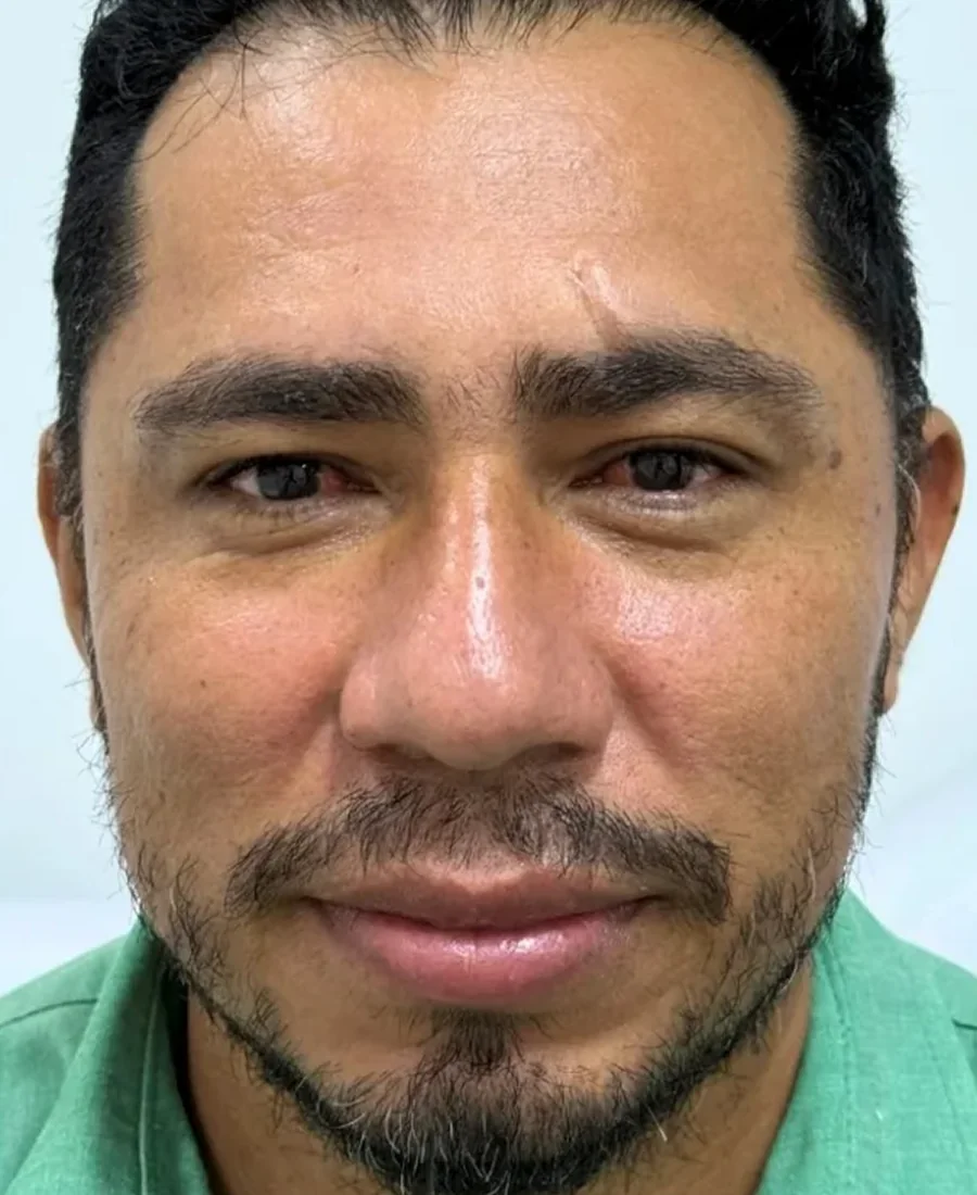 Depois: limpeza de pele