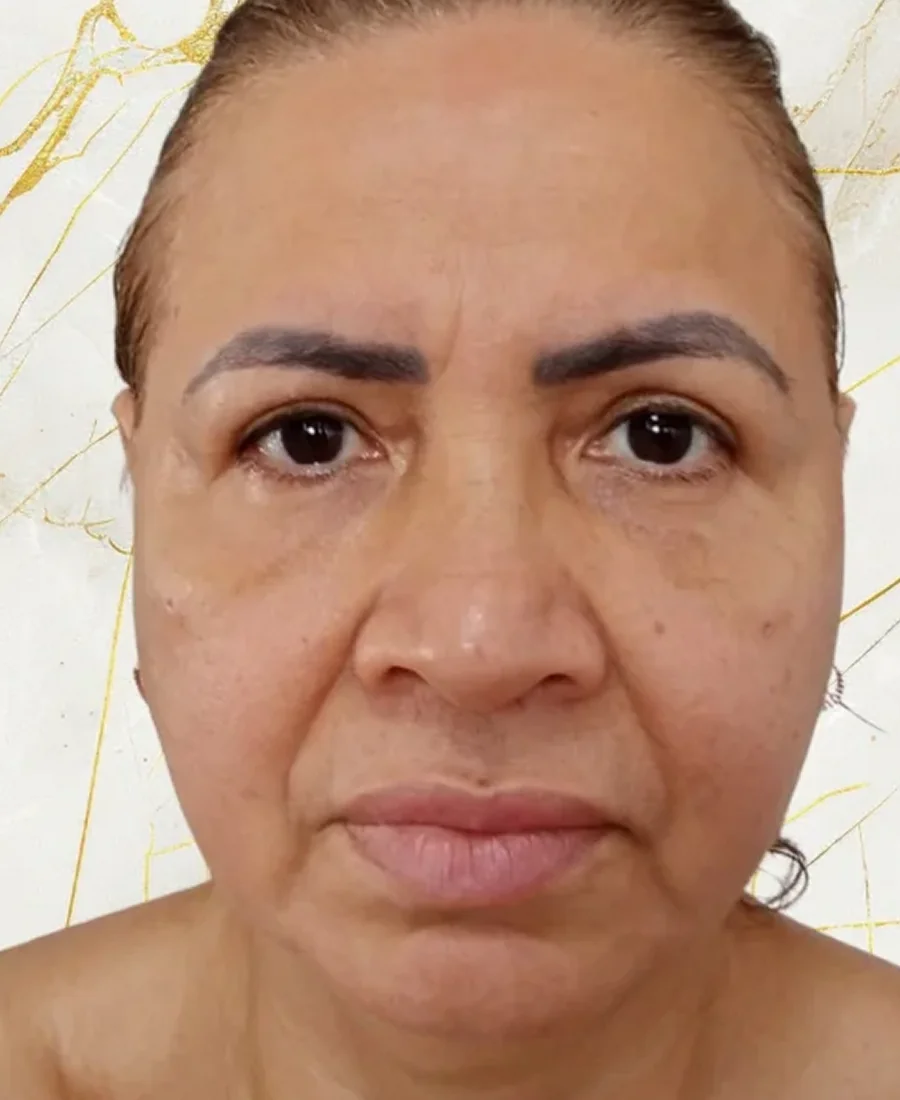 Depois: malar e prp nas olheiras