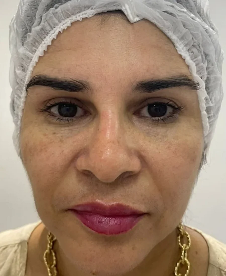 Antes: olheiras com prp