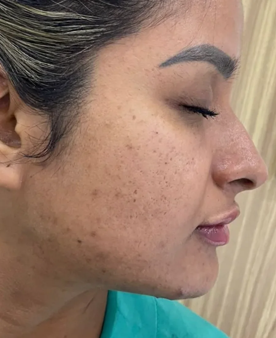 Depois: perfiloplastia